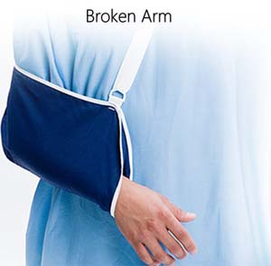 Broken Collarbone