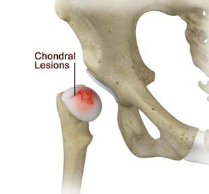 Chondral Lesions or Injuries