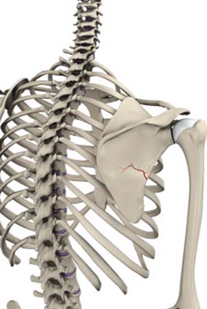 Fracture of the Shoulder Blade (Scapula)