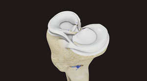 Meniscal Tears