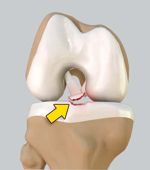 Tibial Eminence Spine Avulsions